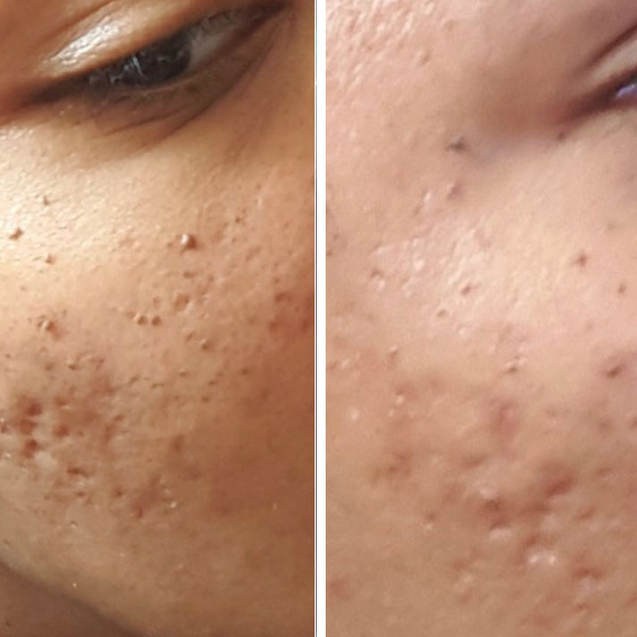 Scars before and after using Ginger Scrub for face and body